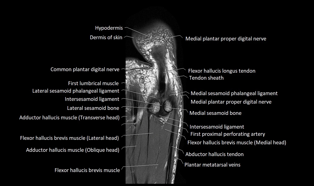 Great Toe micro anatomy MRI axial cross sectional 3T image 21.webp